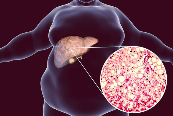 So effektiv können diese Vitamine bei Fettleber helfen